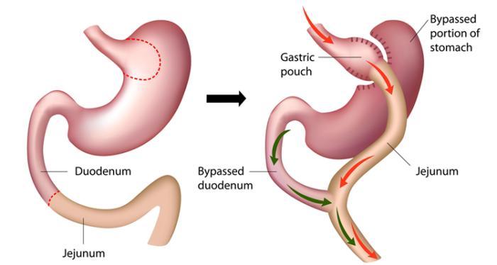 Roux-en-Y Gastric bypass in Istanbul Turkey