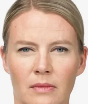eyelid after
