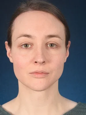 chin surgery genioplasty price turkey before after