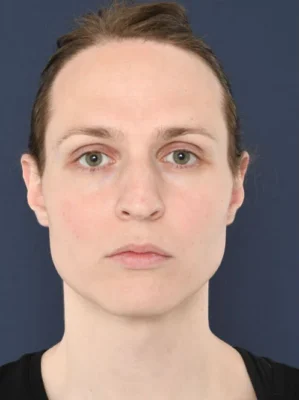 chin surgery genioplasty cost turkey before after chin surgery genioplasty cost turkey before after