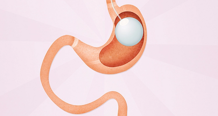 gastric balloon in Istanbul Turkey Gastric Balloon in Istanbul Turkey