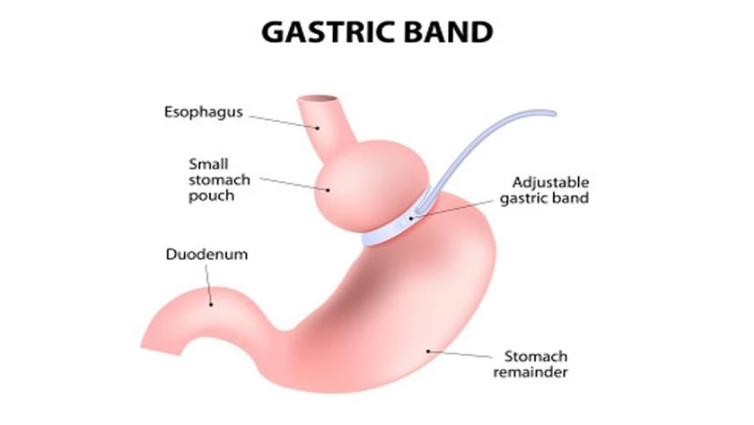 gastric band op in istanbul turkey gastric band op in istanbul turkey