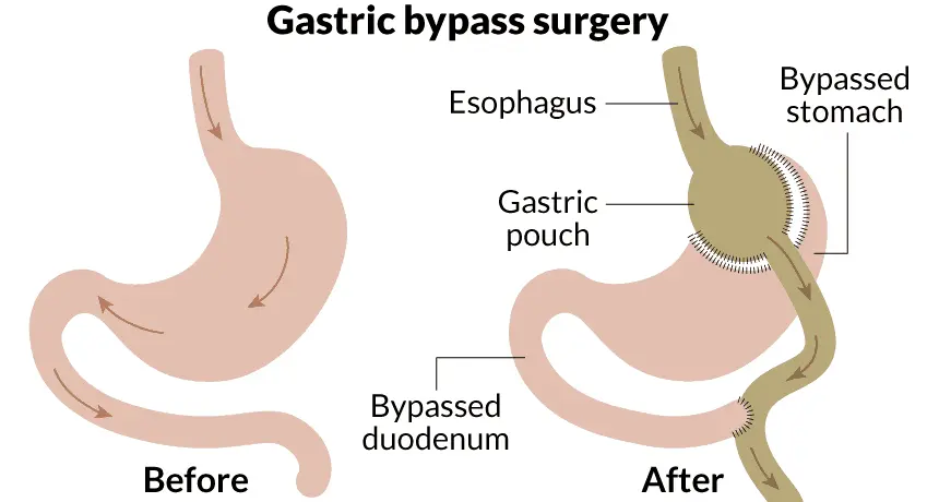 gastric-bypass-surgery-istanbul-turkey Gastric bypass surgery in Istanbul Turkey