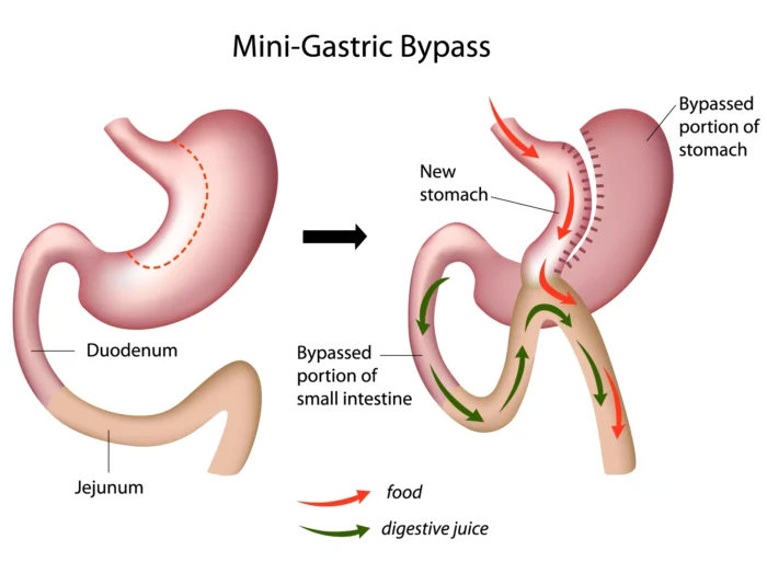 mini gastric bypass surgery in istanbul turkey mini gastric bypass surgery in istanbul turkey