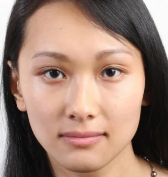 Almond Eye Surgery Before After