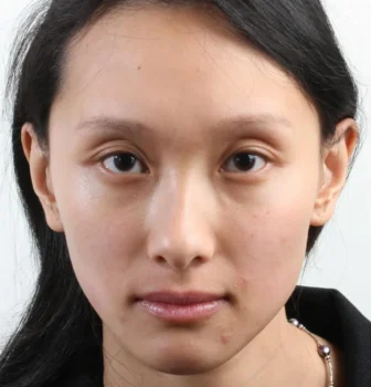 Canthoplasty Almond Eye Surgery Before After Canthoplasty Almond Eye Surgery Before After