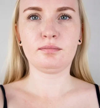 Double Chin Surgery Cost Turkey Istanbul Before After Double Chin Surgery Cost Turkey Istanbul Before After