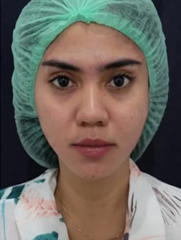 Eyebrow-Lifting-After