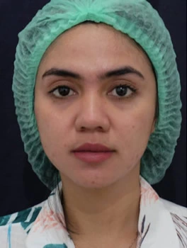 Eyebrow-Lifting-Before