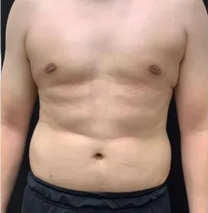 Gynecomastia surgery after