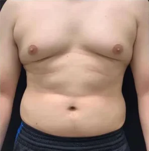 Gynecomastia surgery before