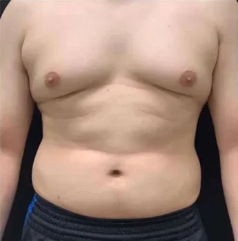 Gynecomastia surgery before Gynecomastia surgery before