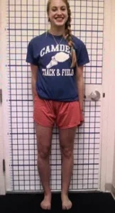 Leg Lengthening After