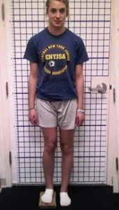 Leg Lengthening Before