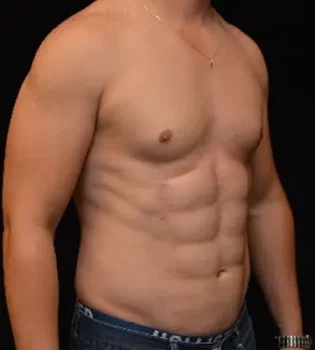Men Abdominal Etching Surgery Before After