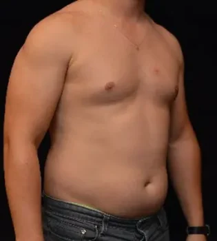 Male Abdominal Etching Surgery Before After Male Abdominal Etching Surgery Before After