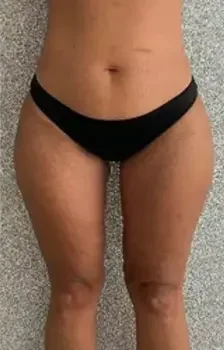 Thigh Lift Surgery After