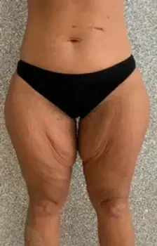 Thigh Lift Surgery Before Thigh Lift Surgery Before