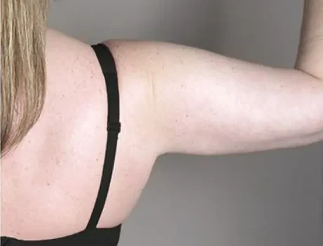 arm lift surgery after