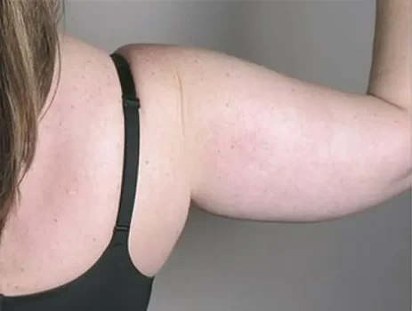 arm lift surgery before arm lift surgery before