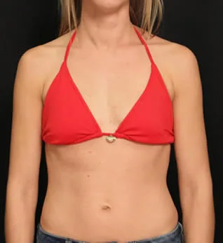 breast surgery before breast surgery before