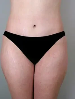 genital surgery for women after