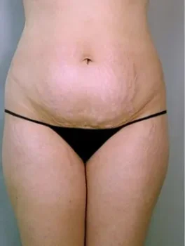 genital surgery before genital surgery before