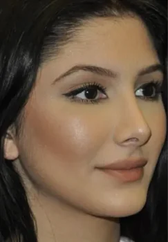 rhinoplasty after