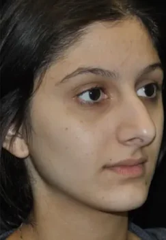 rhinoplasty before wm rhinoplasty before