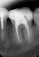 Endodontics after