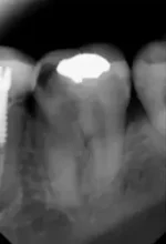Endodontics before