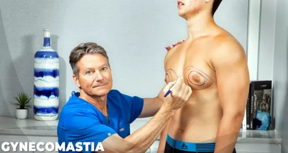 6 Gynecomastia e1705933941478 Gynecomastia cost turkey istanbul