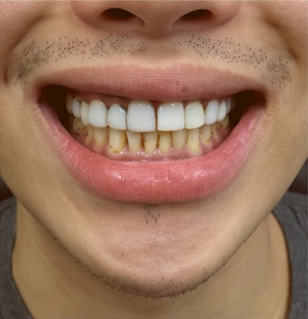 Periodontics Before Periodontics Before