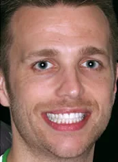 Teeth Whitening after