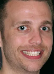 Teeth Whitening before