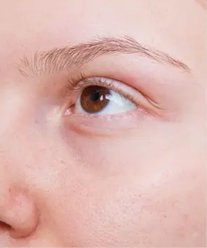 eyebrow transplant before