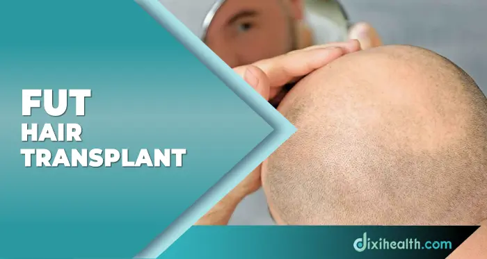 fut hair transplant in istanbul turkey