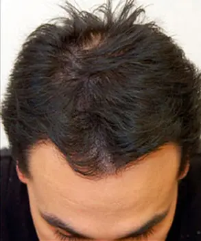 hair mesotherapy after
