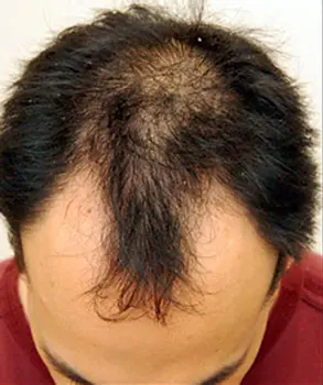 hair mesotherapy before hair mesotherapy before