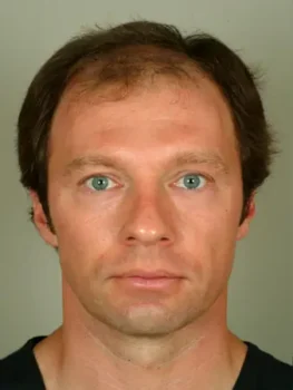 hair transplant turkey cost before after hair transplant turkey cost before after