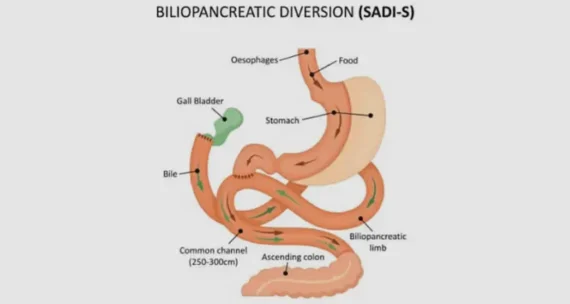 Biliopancreatic Diversion Surgery Turkey
