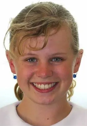 Orthodontic Treatment After