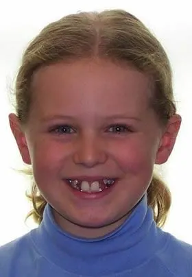 Orthodontic Treatment Before Orthodontic Treatment Before
