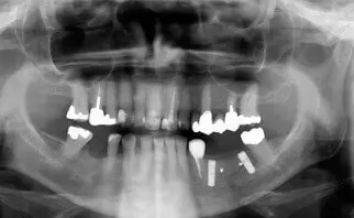 bone augmentation after