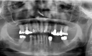 bone augmentation before