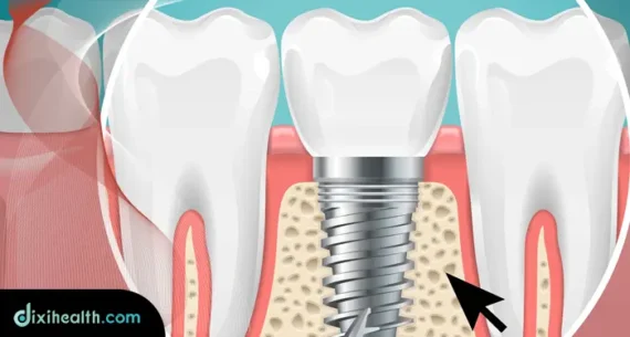 bone augmentation grafting istanbul turkey