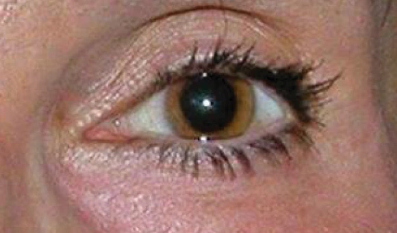 eye treatment after