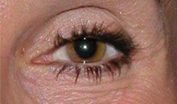 eye treatment before eye treatment before