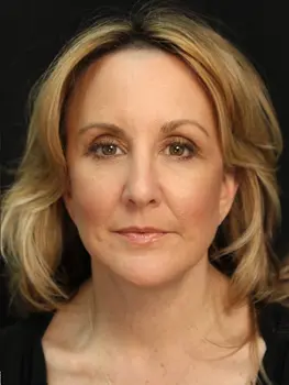 facelift surgery after