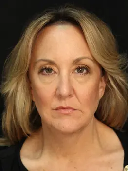 facelift surgery before